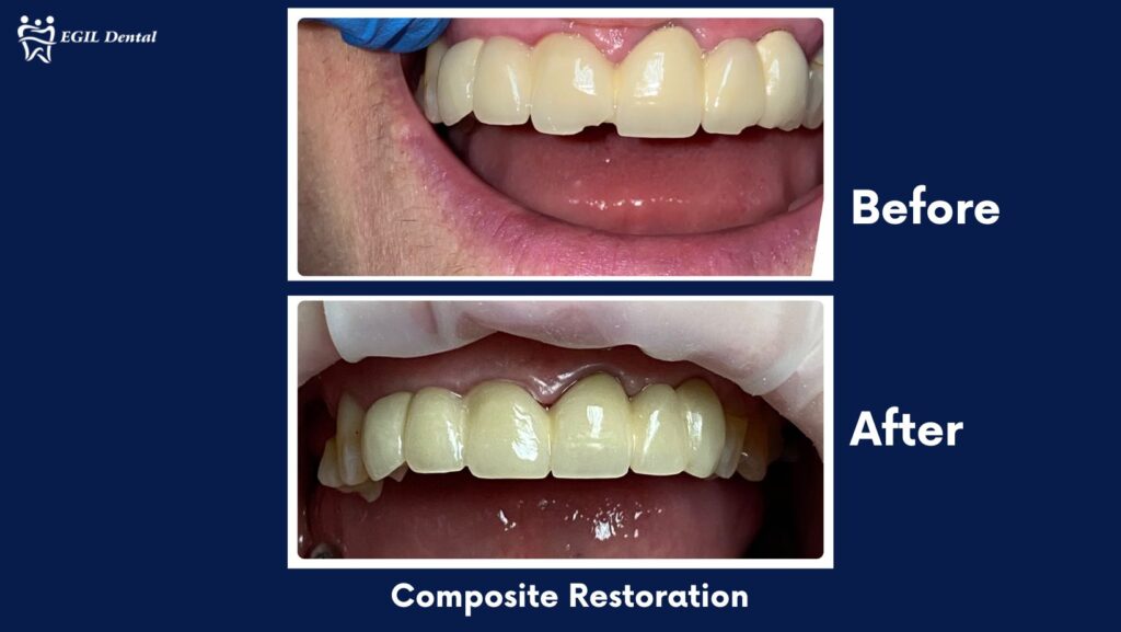 Egil Dental (1) Before and after photos of porcelain crowns.