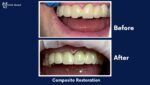 Before and after photos of porcelain crowns.