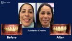 A woman's teeth before and after porcelain crowns.