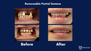 Before and after comparison of a patient's smile with and without a removable partial denture.